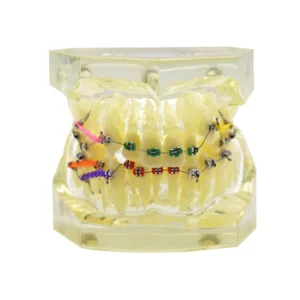 Dental Transparent Teeth Malocclusion Orthodontic Model With Brackets Orthodontic Study Model Metal Arch Wire